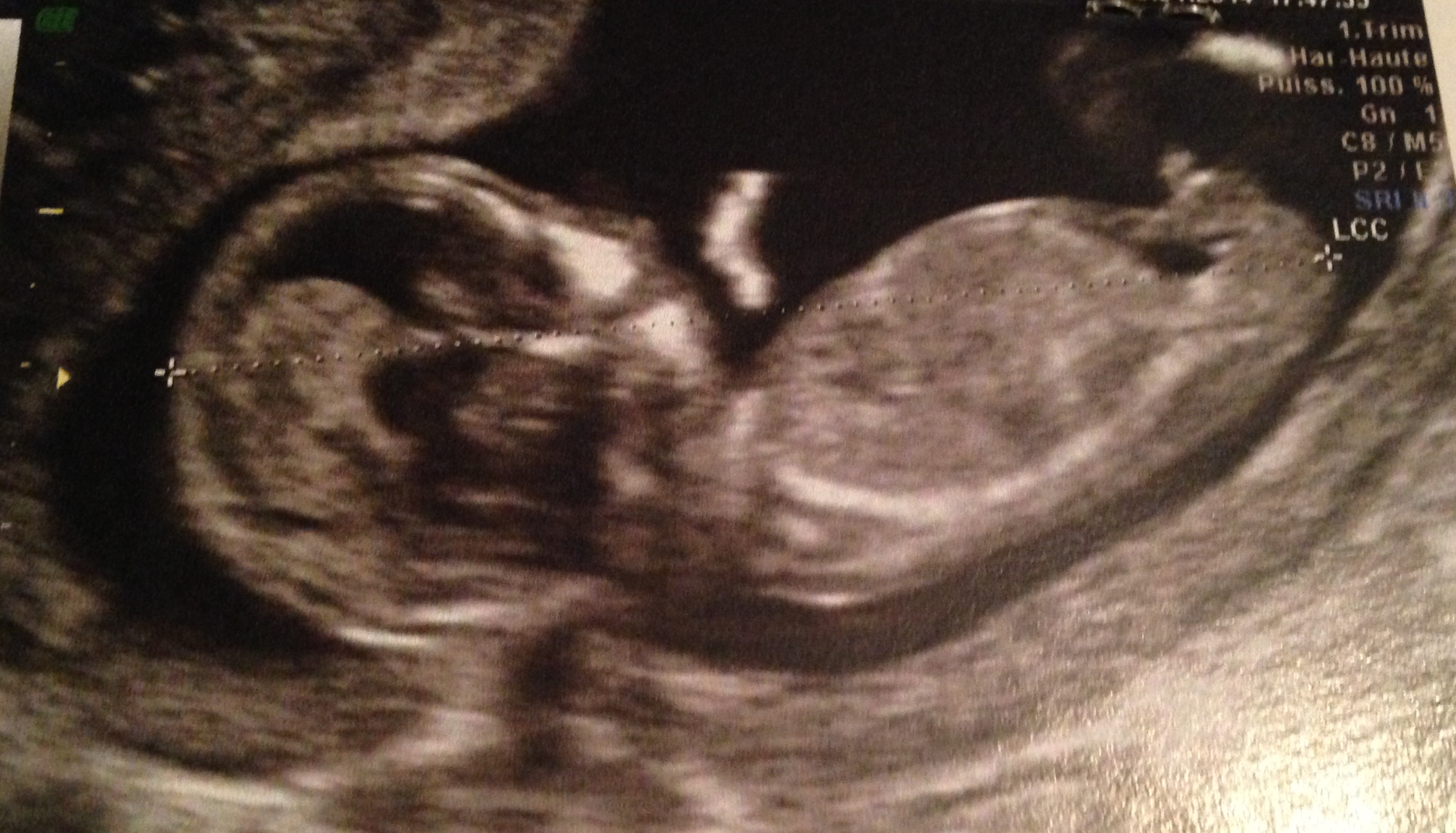 Grossesse Foetus Bebe 3 Mois Une Fille 3 0