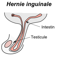 Mon Fils A Une Hernie Inguinale Une Fille 3 0